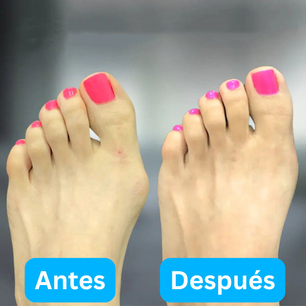 Corrector Juanete en Casa OrtoBand® + Envío GRATIS